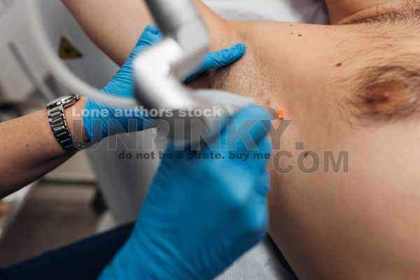 Laser removal of warts on the body in the clinic